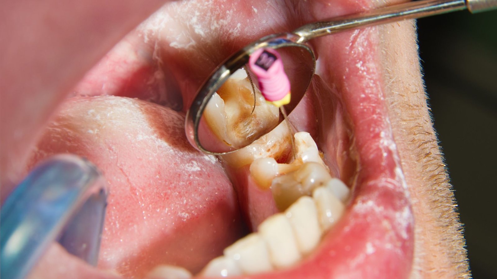 Melhor dentista para endodontia em Ribeirão Preto: tratamento de canal e urgência 24 horas na Mairake Odontologia.